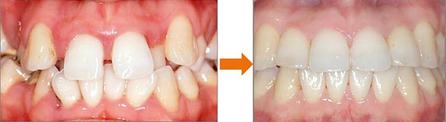 Ortodontik tedavi nasıl uygulanır