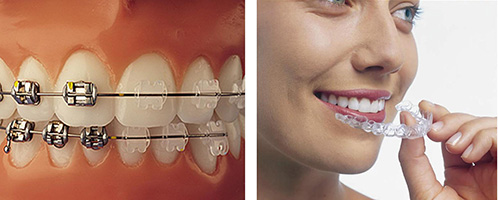 ortodontik tedavi süresi